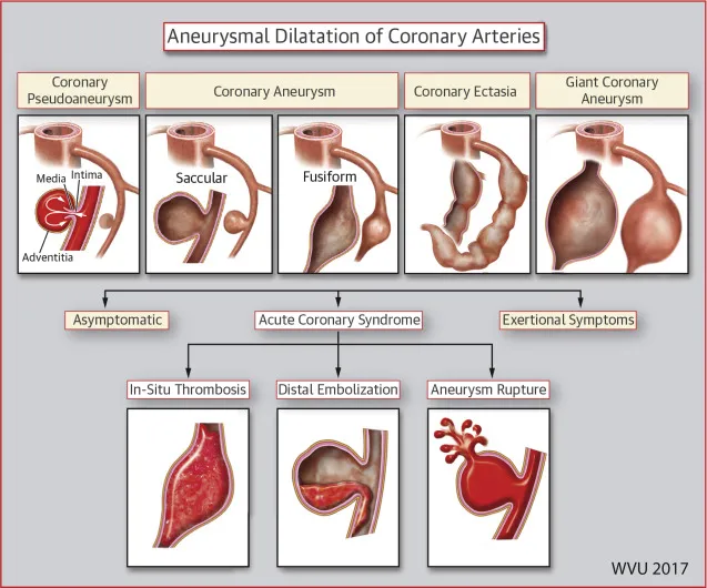 Coronary artery aneurysms: types and complications