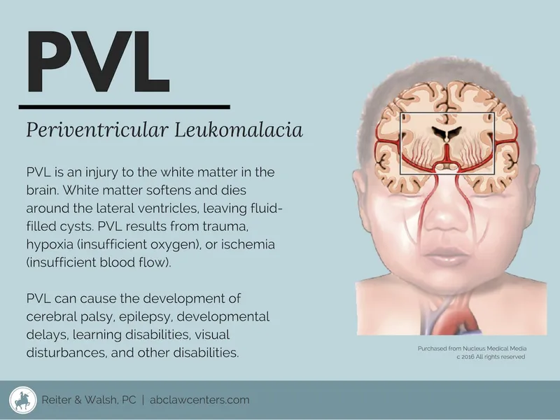 Periventricular Leukomalacia (PVL) and its effects