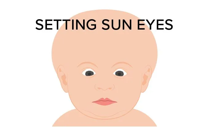 Infant with hydrocephalus showing setting sun sign