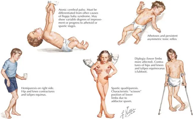 Cerebral Palsy Manifestations in Children