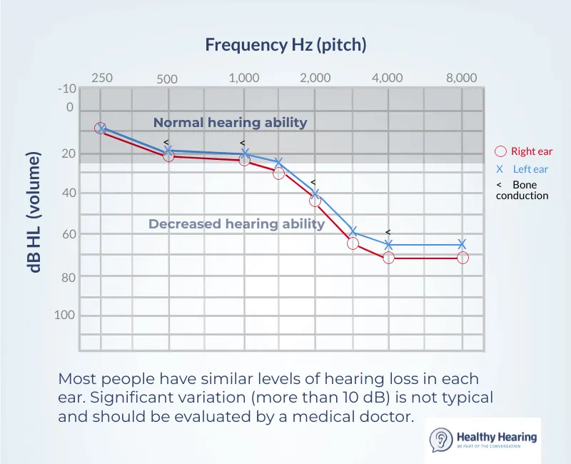 Audiogram showing hearing loss patterns