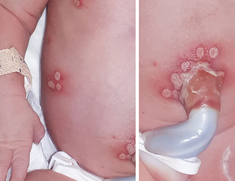 Neonatal Herpes Simplex: Vesicular Lesions & Umbilical Cord