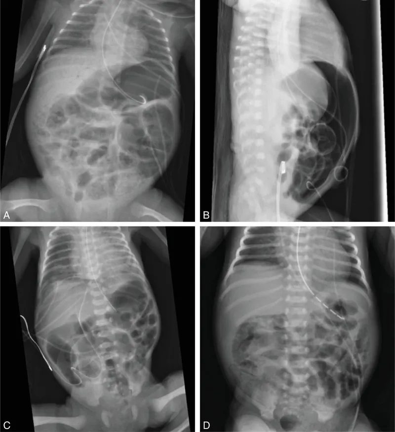 Abdominal X-rays of Necrotizing Enterocolitis