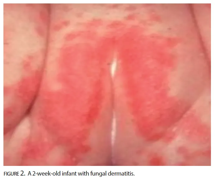 Neonatal candidiasis with satellite lesions in diaper area