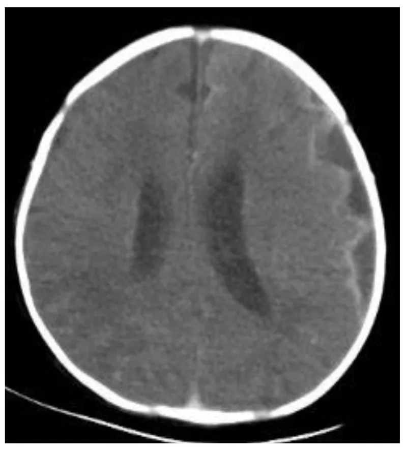 CT brain showing hydrocephalus post neonatal meningitis