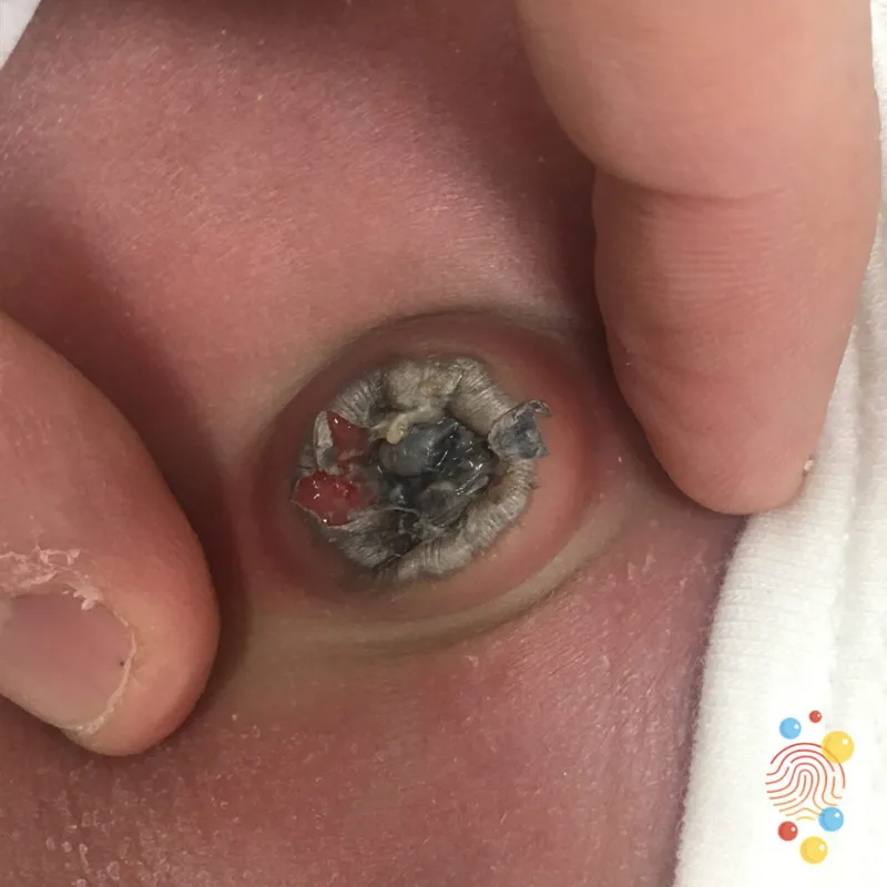 Neonatal Omphalitis with Purulent Discharge