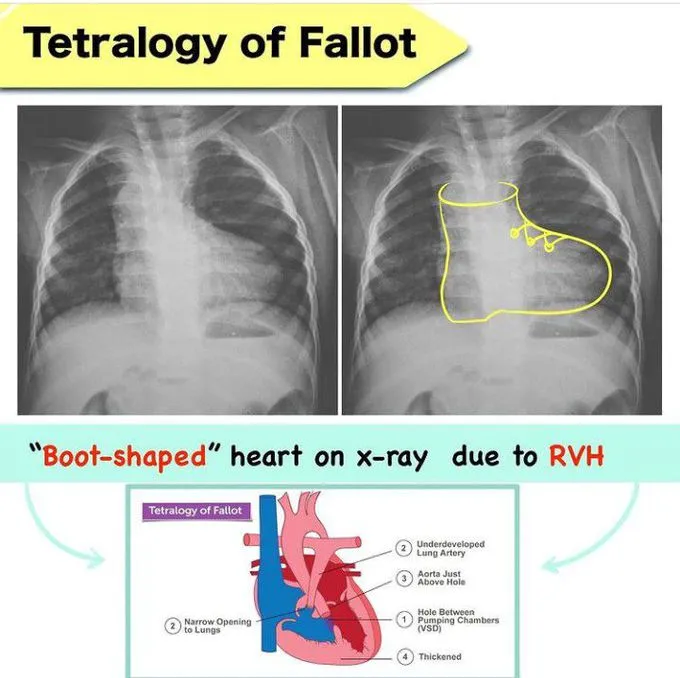 Tetralogy of Fallot: X-ray and diagram