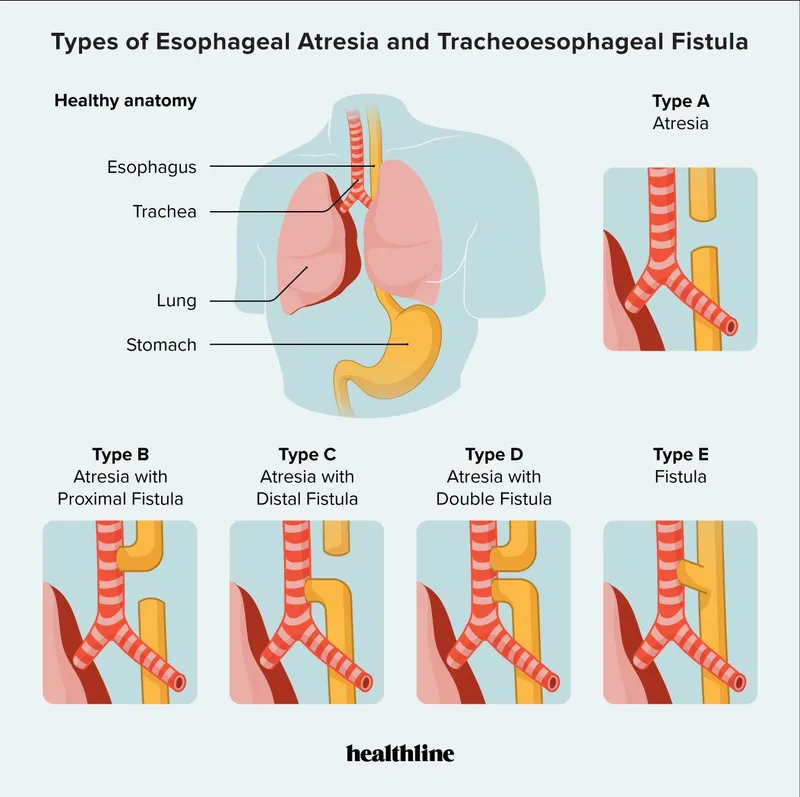 Types of Esophageal Atresia and Tracheoesophageal Fistula
