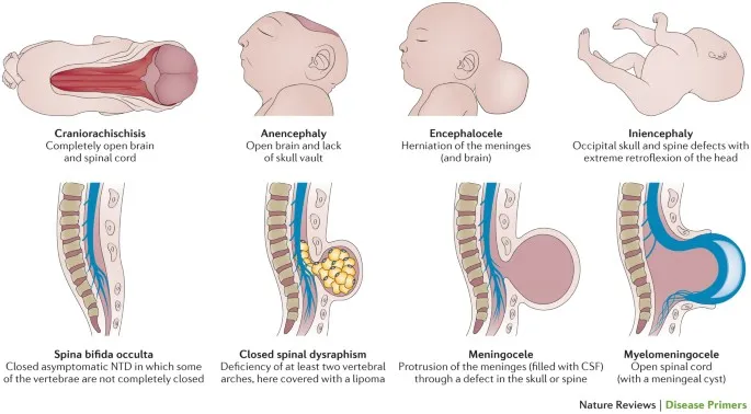 Types of Neural Tube Defects