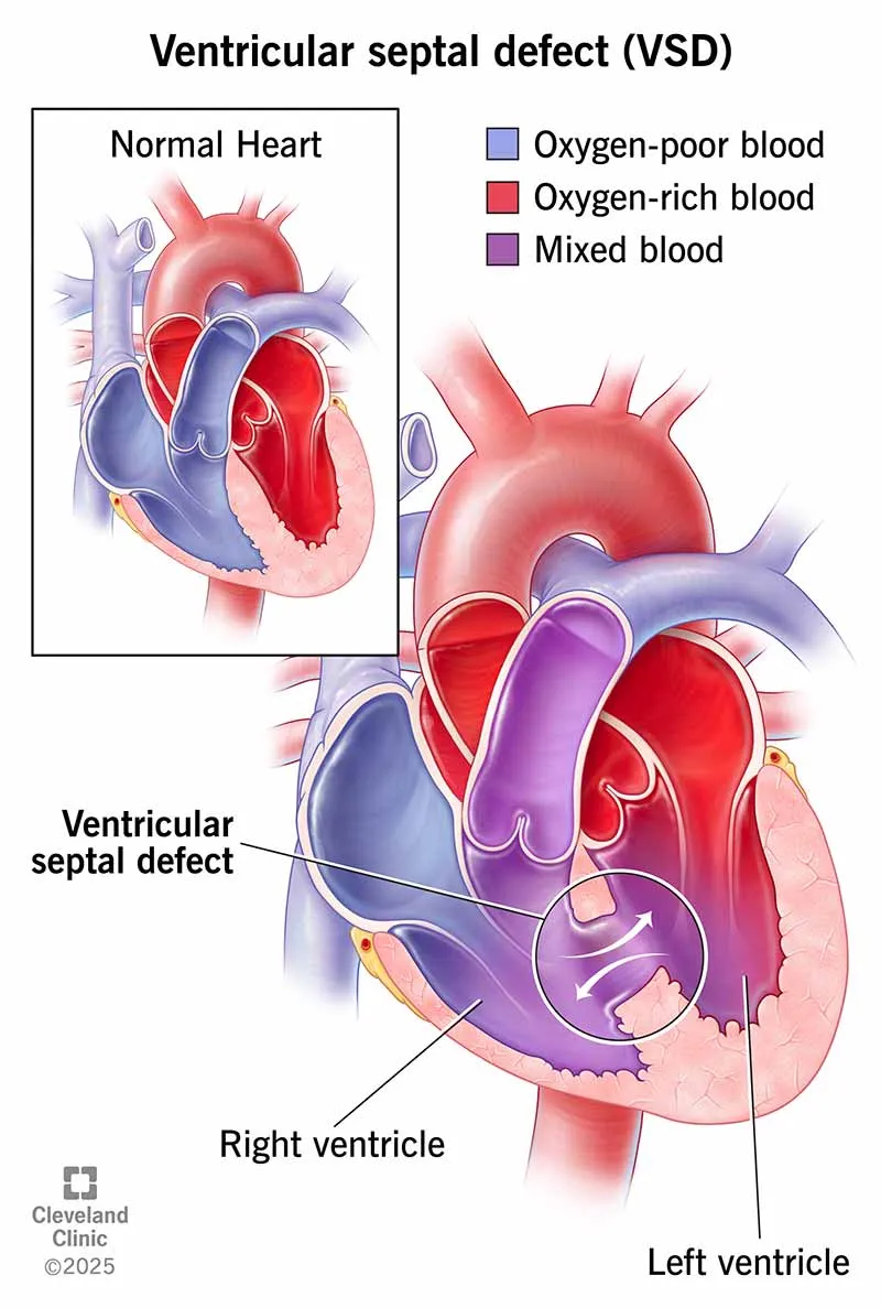 Ventricular Septal Defect (VSD) Illustration