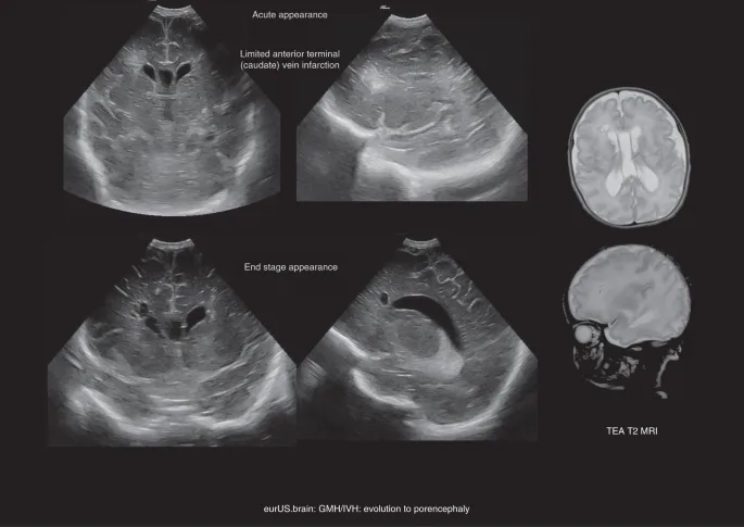 Neonatal brain ultrasound: GMH/IVH evolution to porencephaly
