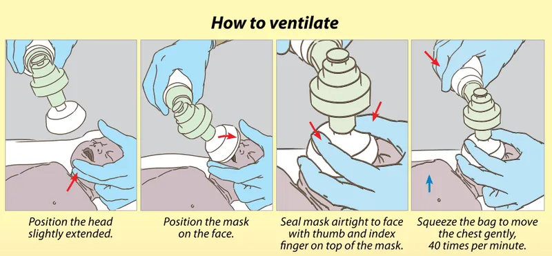 Neonatal bag-mask ventilation steps