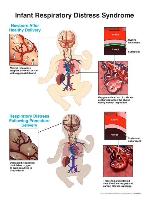 Infant Respiratory Distress Syndrome Comparison
