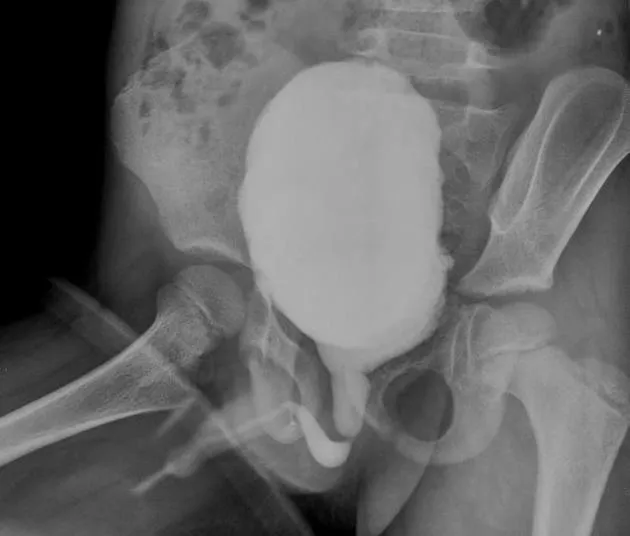 MCU showing dilated posterior urethra in PUV