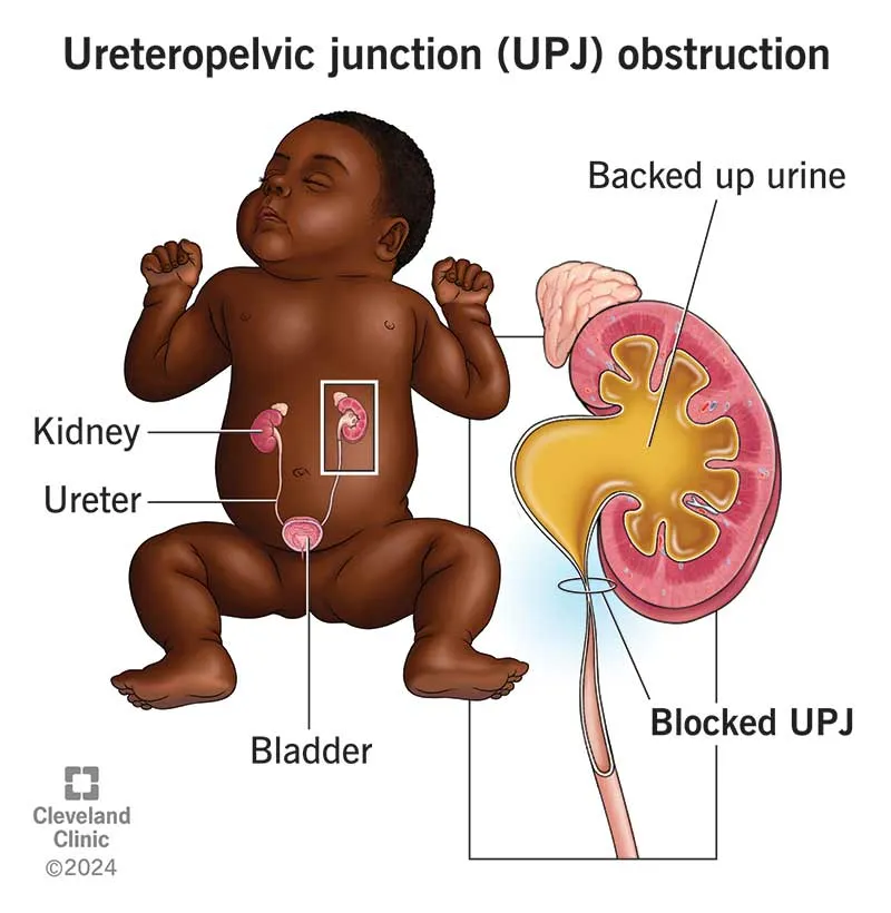 UPJ obstruction in infant