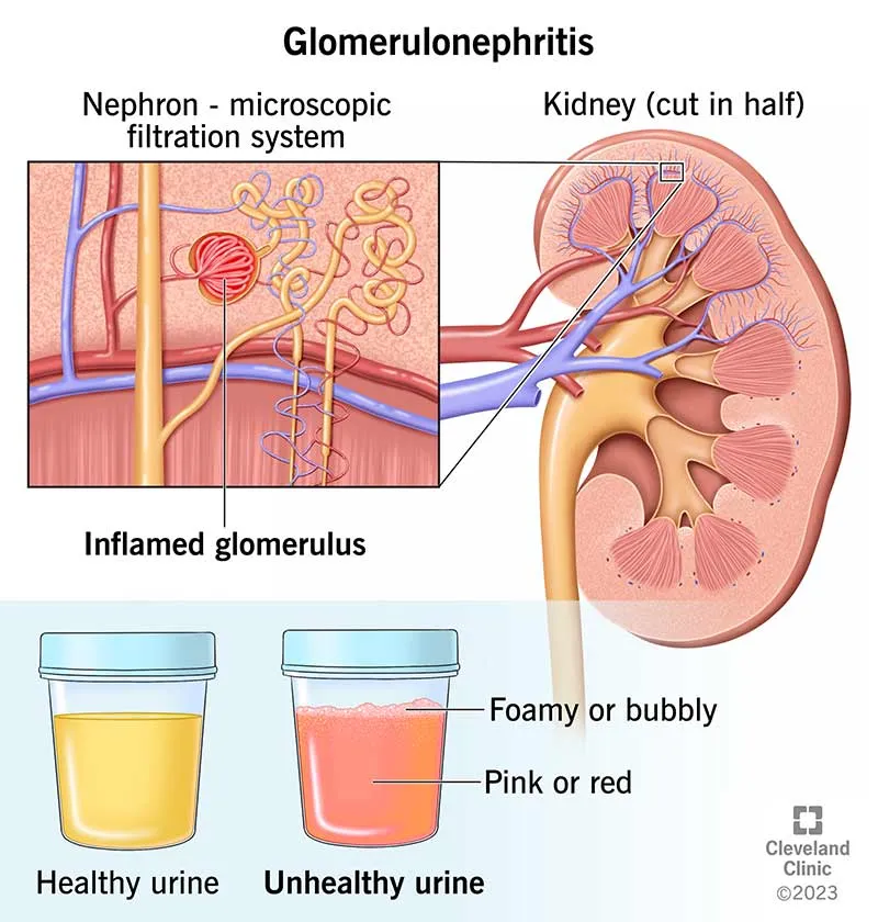 Glomerulonephritis and urine changes