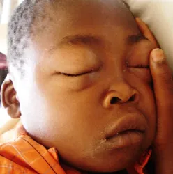Child with periorbital edema from nephrotic syndrome