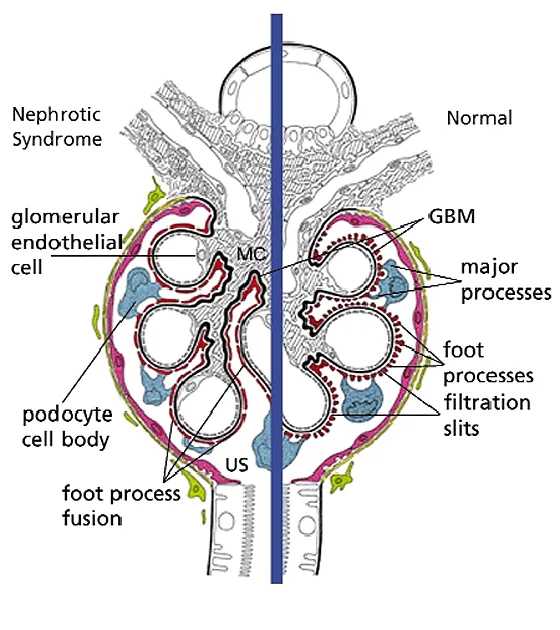 Podocyte foot process effacement in nephrotic syndrome