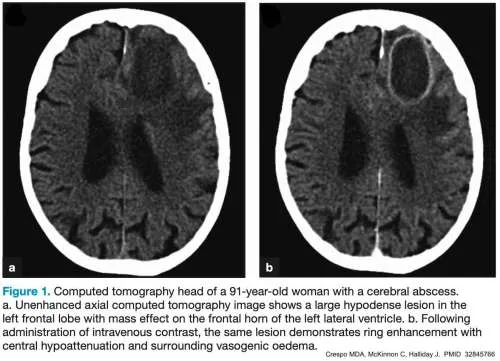 CT brain showing ring-enhancing lesion