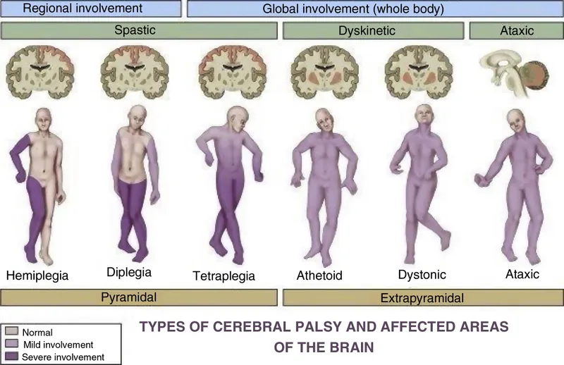 Types of Cerebral Palsy and Affected Brain Areas
