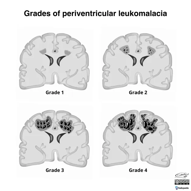 Grades of periventricular leukomalacia diagram