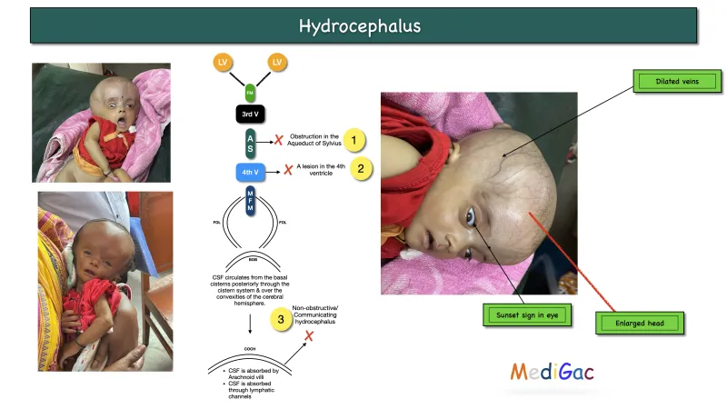 Infant Hydrocephalus Clinical Signs