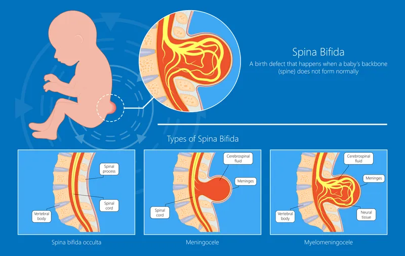 Spina Bifida Types: Occulta, Meningocele, Myelomeningocele