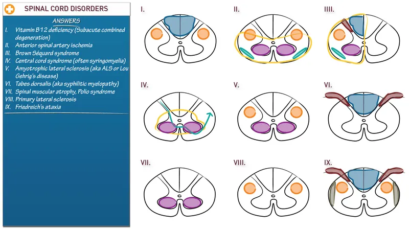 Spinal Cord Disorders Diagram
