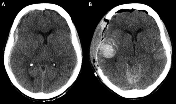 Axial CT: Pediatric Extradural Hematoma