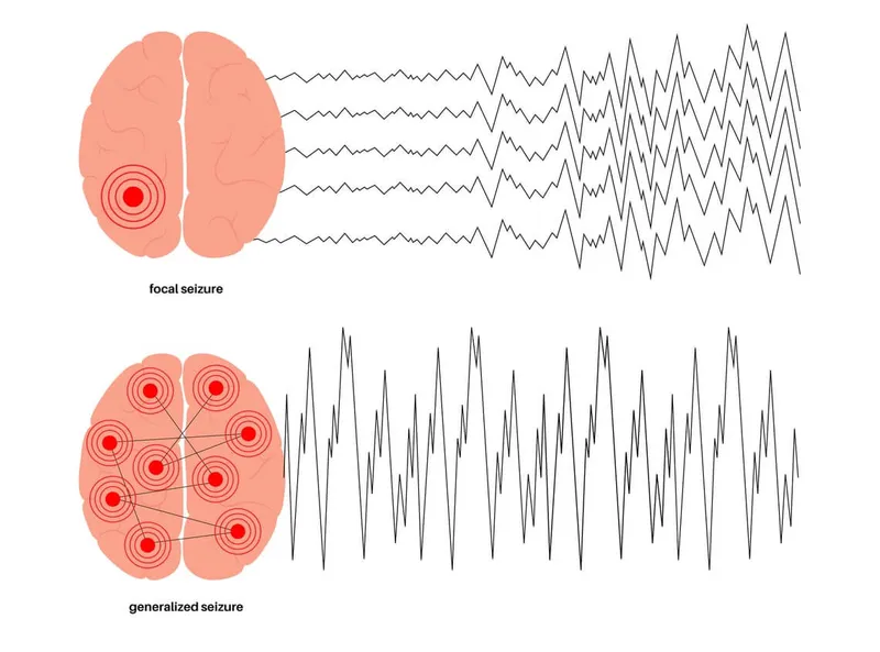 Focal vs. Generalized Seizure Brain Activity and EEG