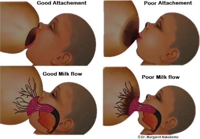 Good vs. Poor Breastfeeding Latch and Milk Flow