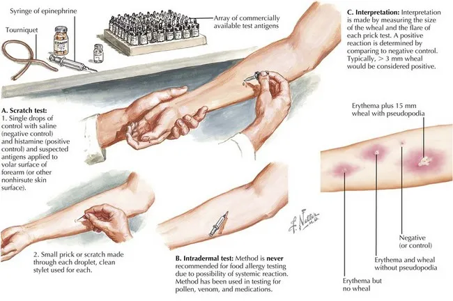 Skin Prick Test for Allergies