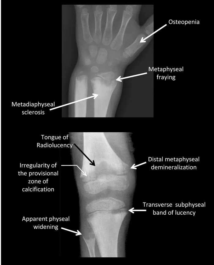 X-ray findings of rickets in wrist and knee