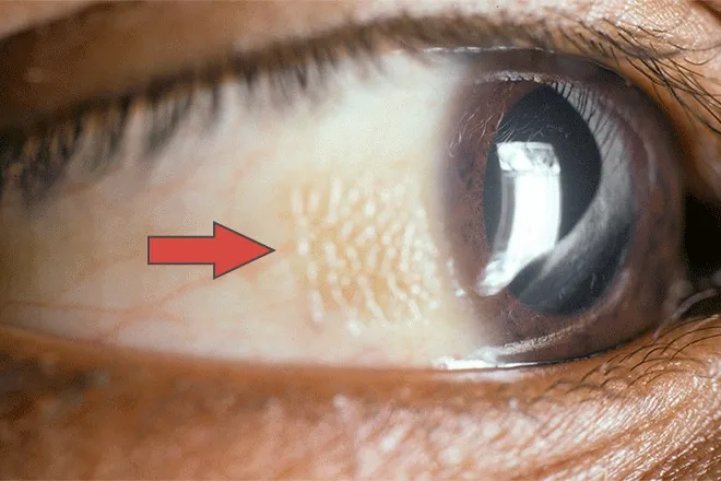 Bitot's spots on conjunctiva due to Vitamin A deficiency
