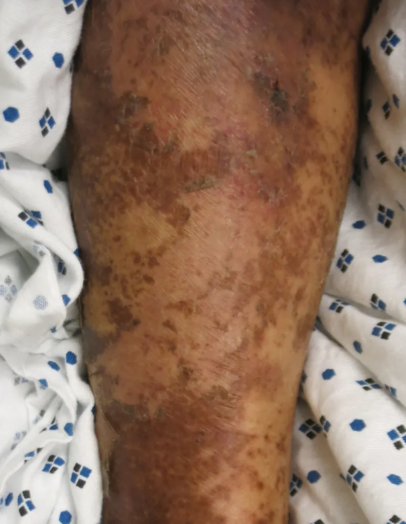 Dermatosis in protein-energy malnutrition