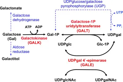 Galactosemia metabolic pathway and GALT enzyme block
