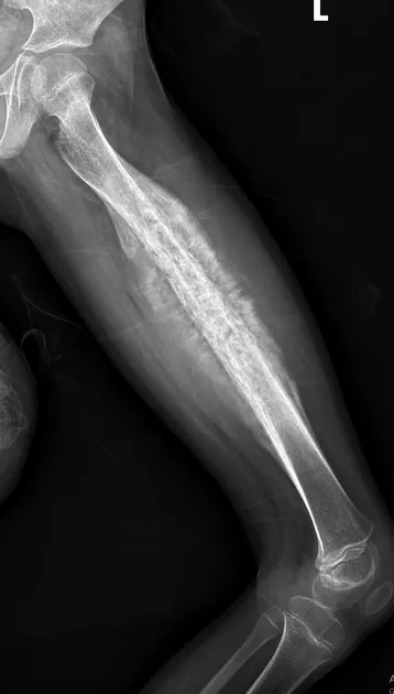 Ewing Sarcoma X-ray with Onion Peel Appearance