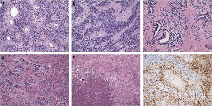 Histopathology of pediatric posterior fossa tumors