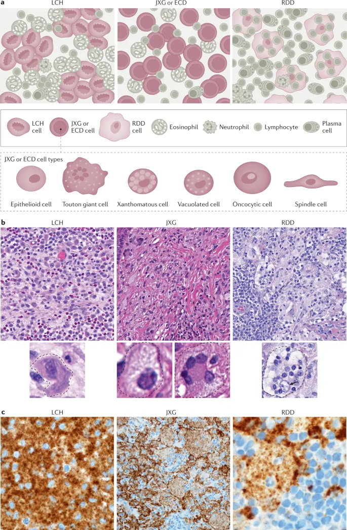 Histopathology of Histiocytosis Syndromes