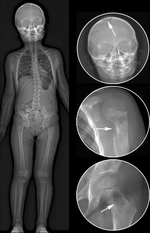 Lytic bone lesions in Langerhans Cell Histiocytosis