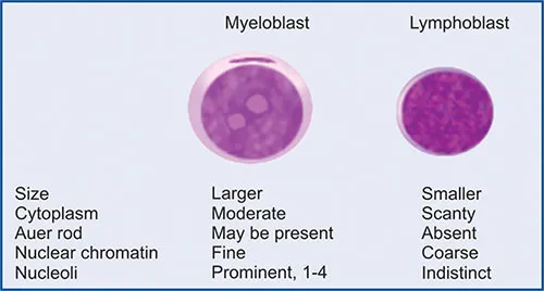 Myeloblast vs Lymphoblast Morphology