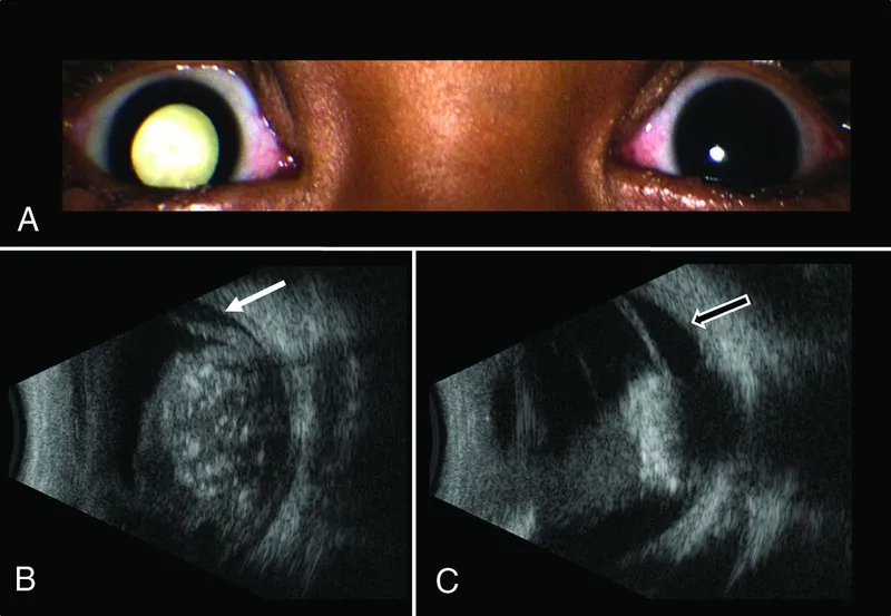 Retinoblastoma: Leukocoria and Ultrasound