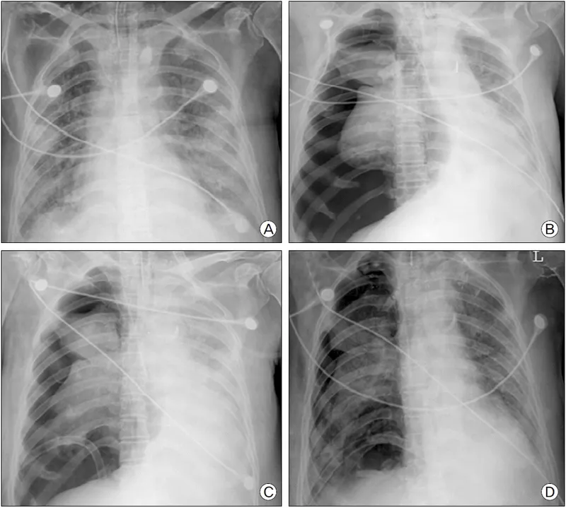 Chest X-ray showing pneumothorax