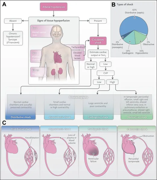Types of Shock: Pathophysiology and Characteristics
