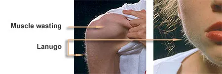 Anorexia Nervosa: Muscle Wasting and Lanugo Hair