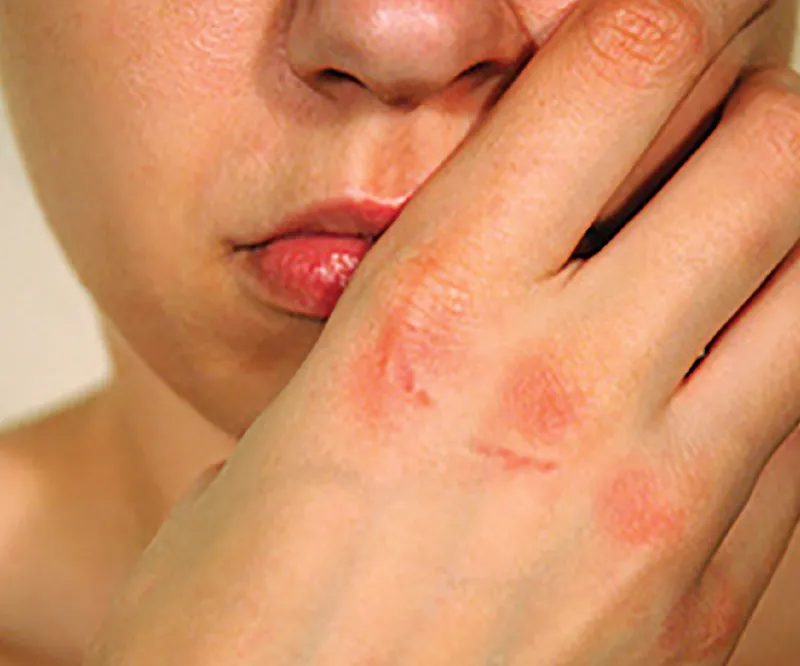 Russell's Sign: Calluses and abrasions on the hand