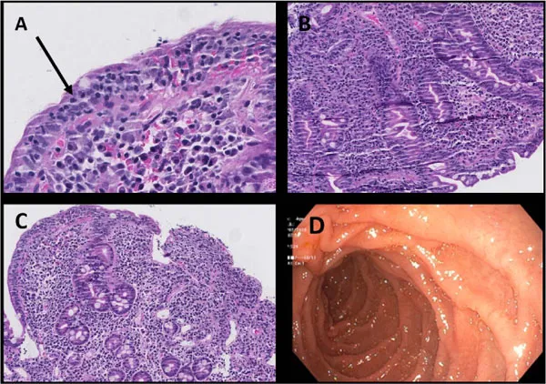 Duodenal biopsy and endoscopy in celiac disease
