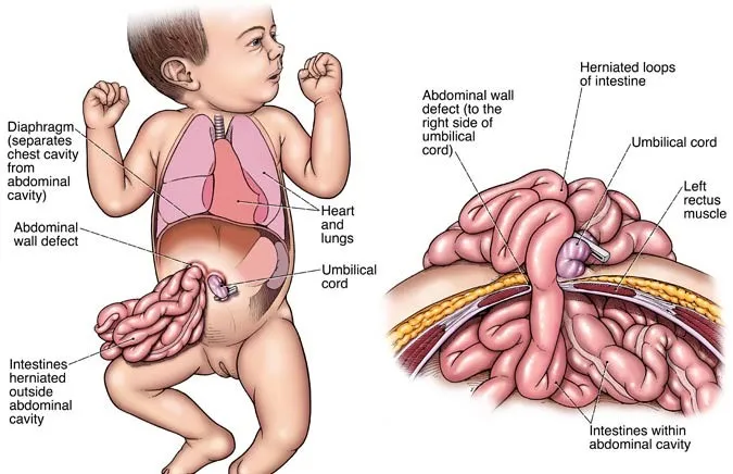 Gastroschisis: Abdominal Wall Defect with Exposed Bowel