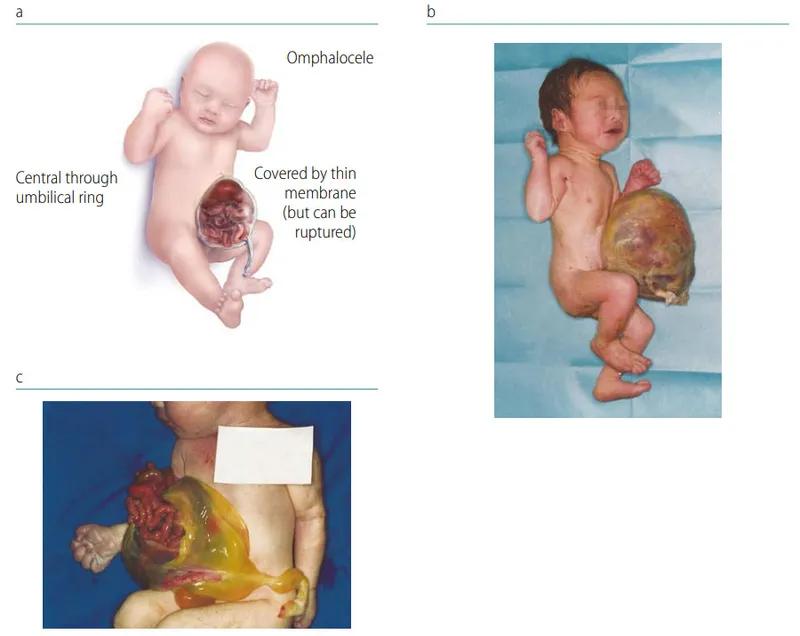 Omphalocele: Intact vs. Ruptured Sac