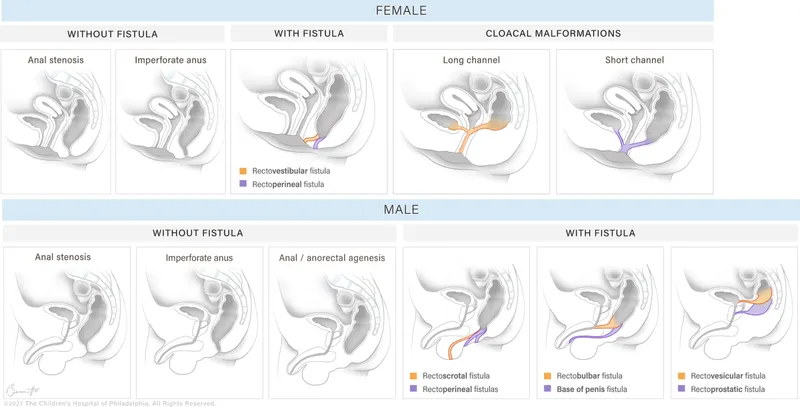 Anorectal Malformations: Female and Male Types
